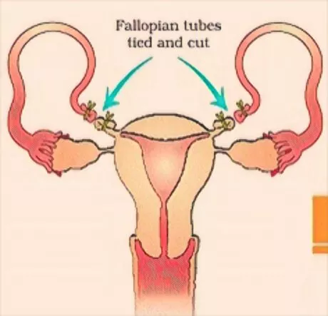 Tubectomy : Reproductive Health