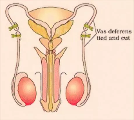 Vasectomy: Reproductive Health